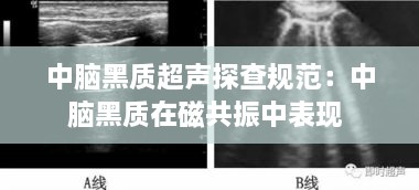 中脑黑质超声探查规范：中脑黑质在磁共振中表现 