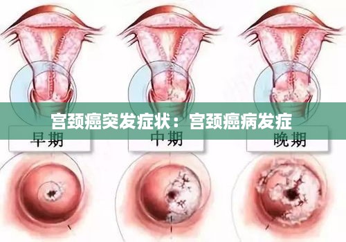 宫颈癌突发症状：宫颈癌病发症 
