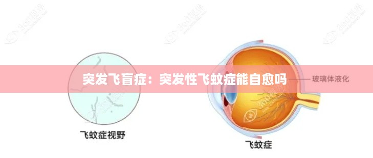 突发飞盲症：突发性飞蚊症能自愈吗 